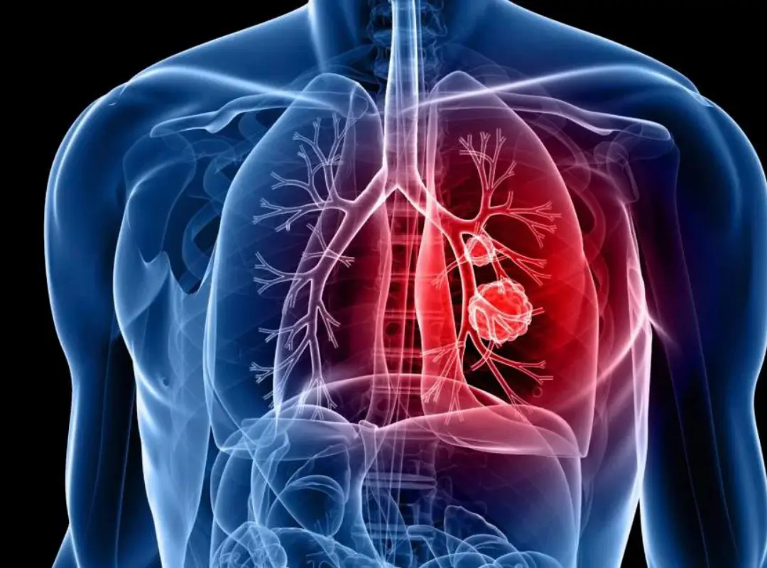 Thoracic Surgery